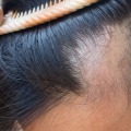 Understanding Alopecia: Causes, Treatments, and Support for Entrepreneurs in New Zealand