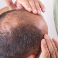 Understanding the Connection Between Stress and Hair Loss