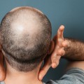 Genetics and Male Pattern Baldness: Understanding the Connection