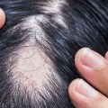 Understanding the Link Between Iron-Deficiency Anemia and Hair Loss