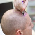 Hair Transplants: A Comprehensive Guide to Starting a Business in New Zealand