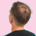 Understanding Male Pattern Baldness in New Zealand