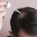 Understanding and Treating Female Hair Loss in New Zealand