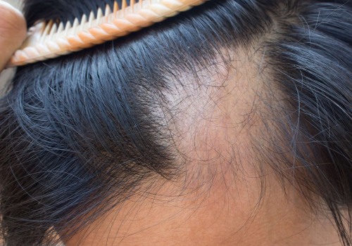Understanding Alopecia: Causes, Treatments, and Support for Entrepreneurs in New Zealand