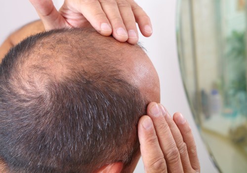 Understanding the Connection Between Stress and Hair Loss