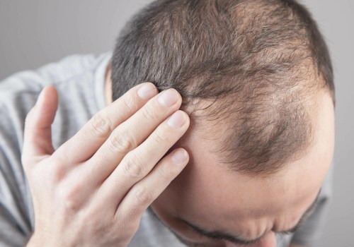 Understanding Hereditary Hair Loss: A Comprehensive Guide for Entrepreneurs in New Zealand