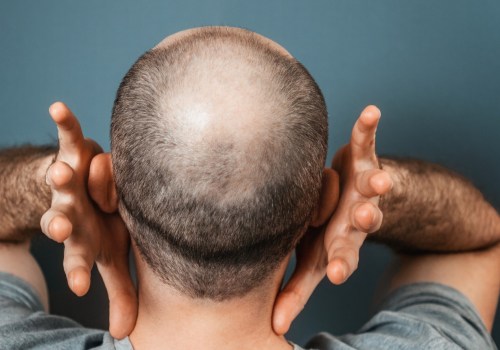 Genetics and Male Pattern Baldness: Understanding the Connection