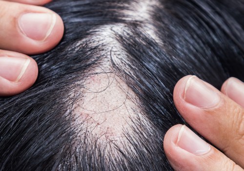 Understanding the Link Between Iron-Deficiency Anemia and Hair Loss