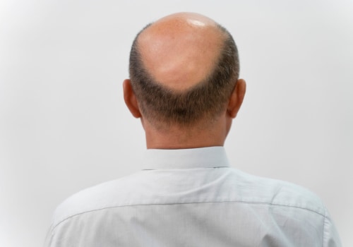 Lifestyle Changes for Preventing Male Pattern Baldness: A Comprehensive Guide for Entrepreneurial Men in New Zealand