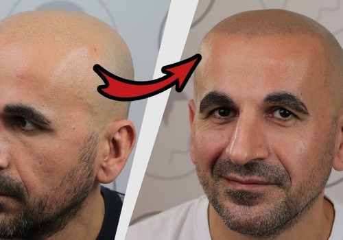 Scalp Camouflage Techniques for Hair Loss: A Comprehensive Guide