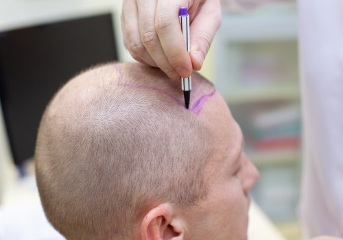 Hair Transplants: A Comprehensive Guide to Starting a Business in New Zealand