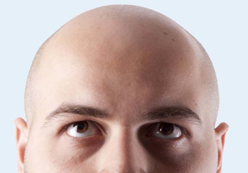 Finasteride: The Solution to Hair Loss for Entrepreneurs in New Zealand