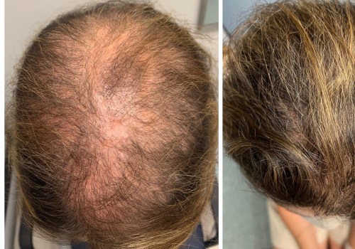 Understanding Minoxidil for Hair Loss Treatment