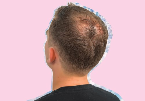 Understanding Male Pattern Baldness in New Zealand